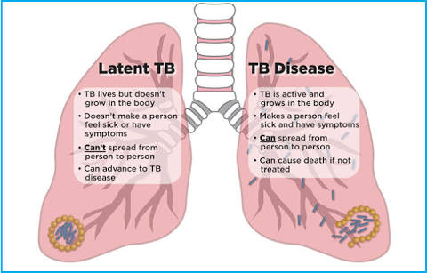 A New Good Medicine Pretomanid With Bedaquiline And Llinezolid For XDR And MDR Tuberculosis