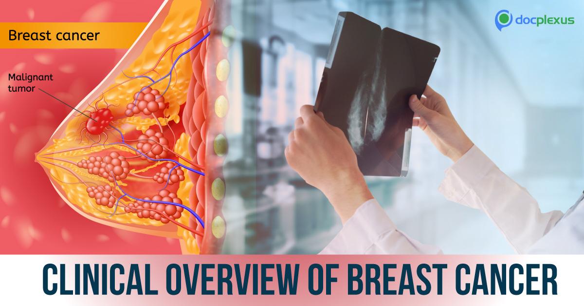 Clinical Guide On Breast Cancer