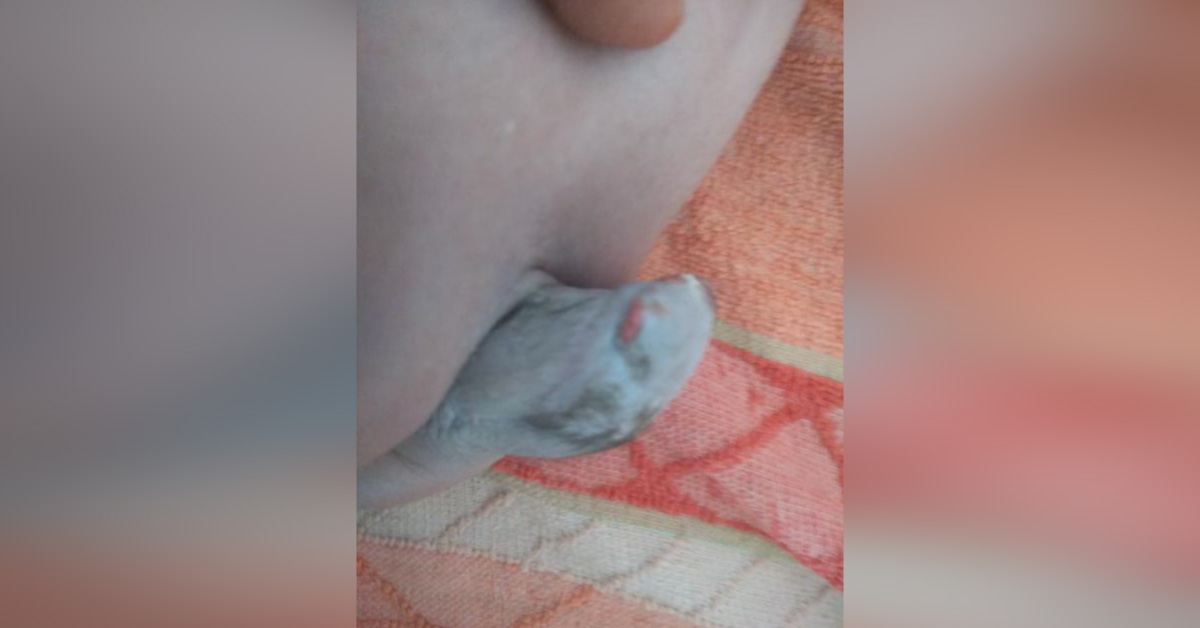 Hairy Mass At Sacrococcygeal Region In A New Born