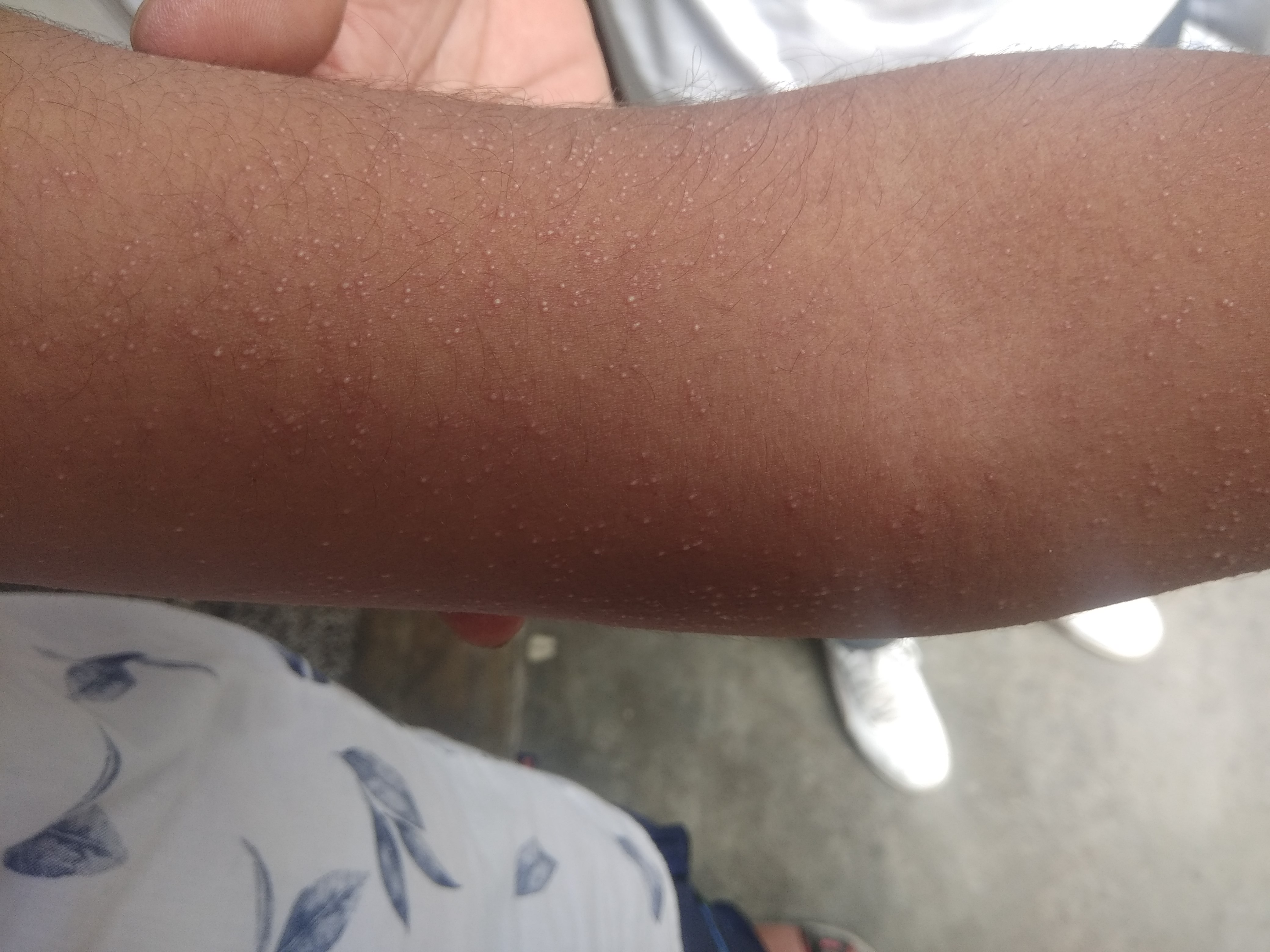 Fever With Rash In A 12-Year-Old