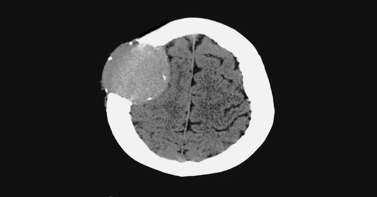 A Woman With A Coin-Sized Scalp Lump