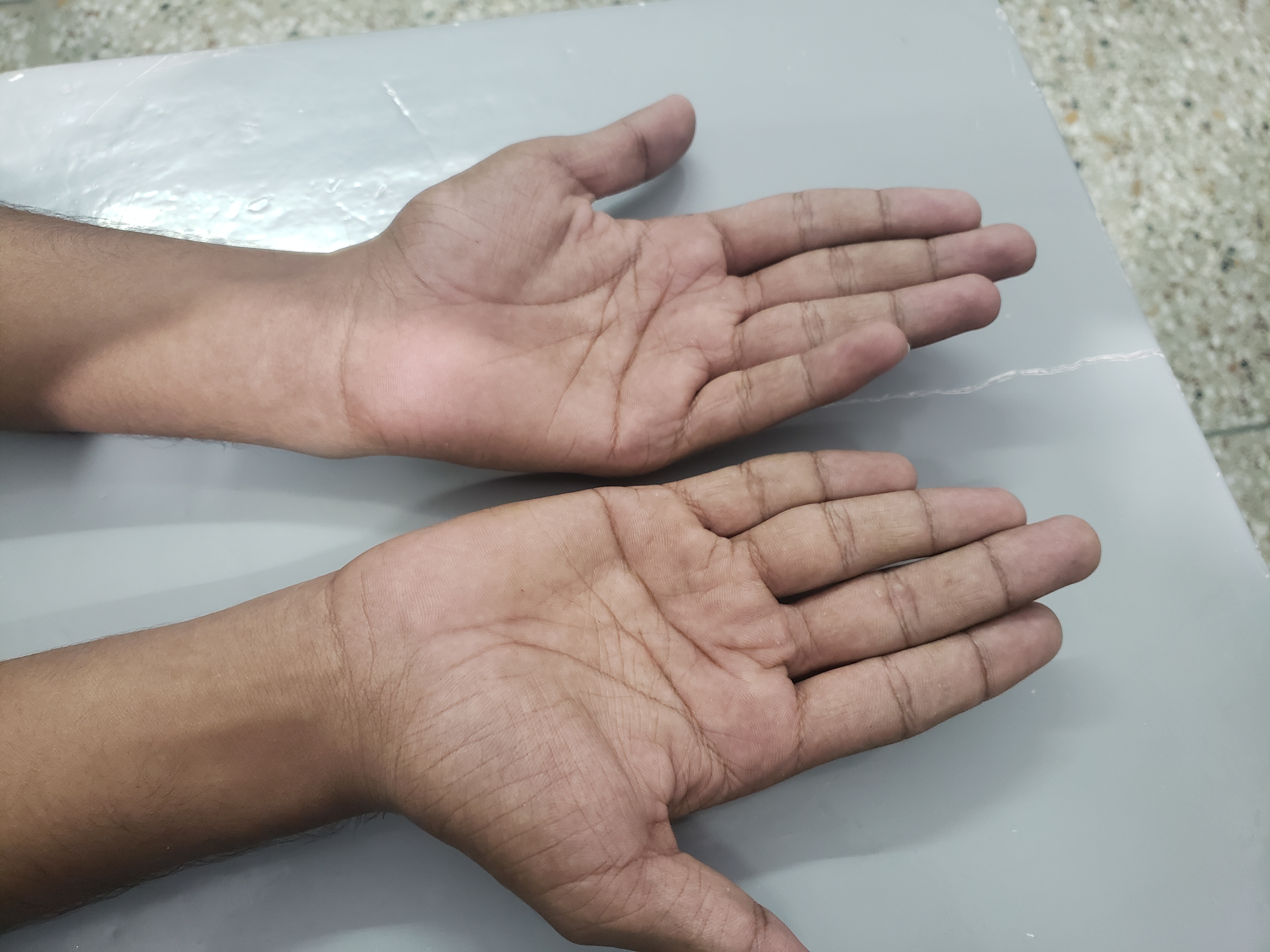 Is This A Case Of Leprosy Or Antifungals Drugs Induced Toxic Neuropathy?