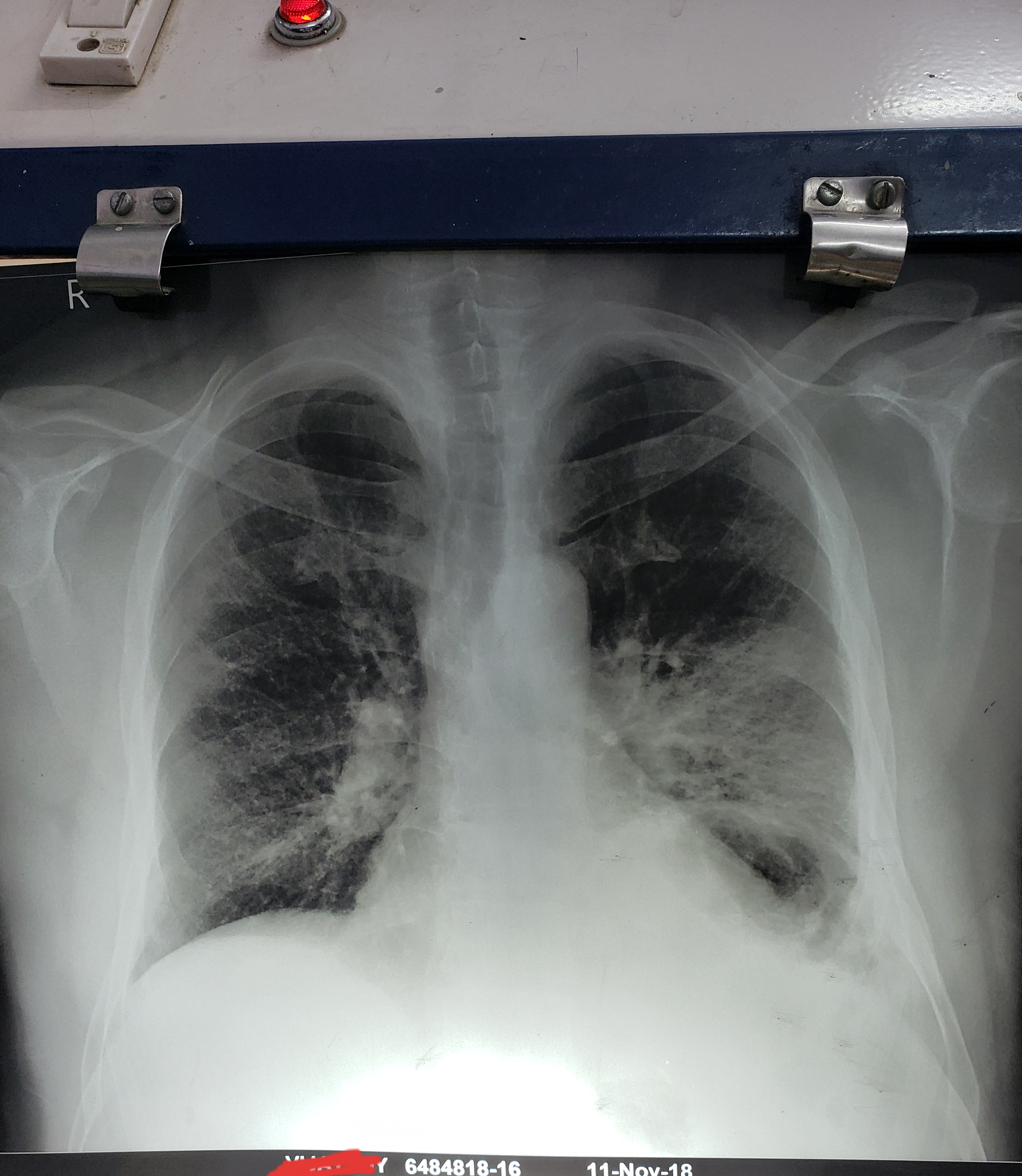 Case Report Of A Patient Recovered From Toxicity Of Fiberglass Lung Disease