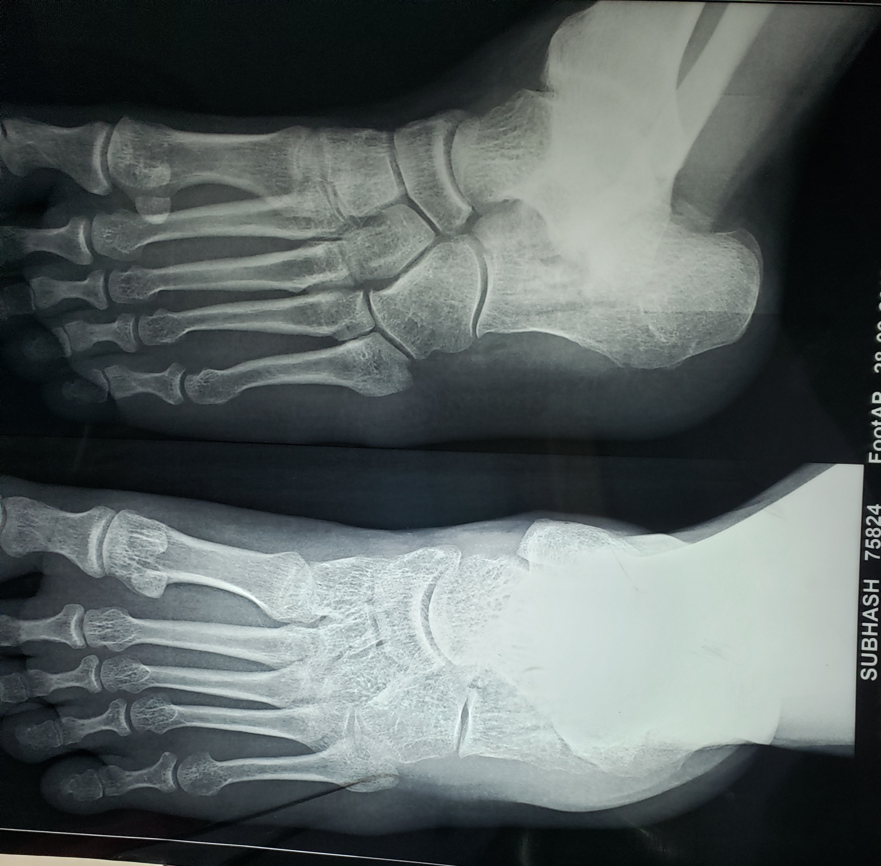 Is There Any Fracture In Calcaneus Bone At Planter Side?