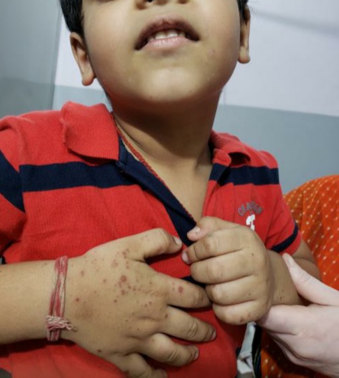 What Is This Skin Problem In 5 Years Child -----2