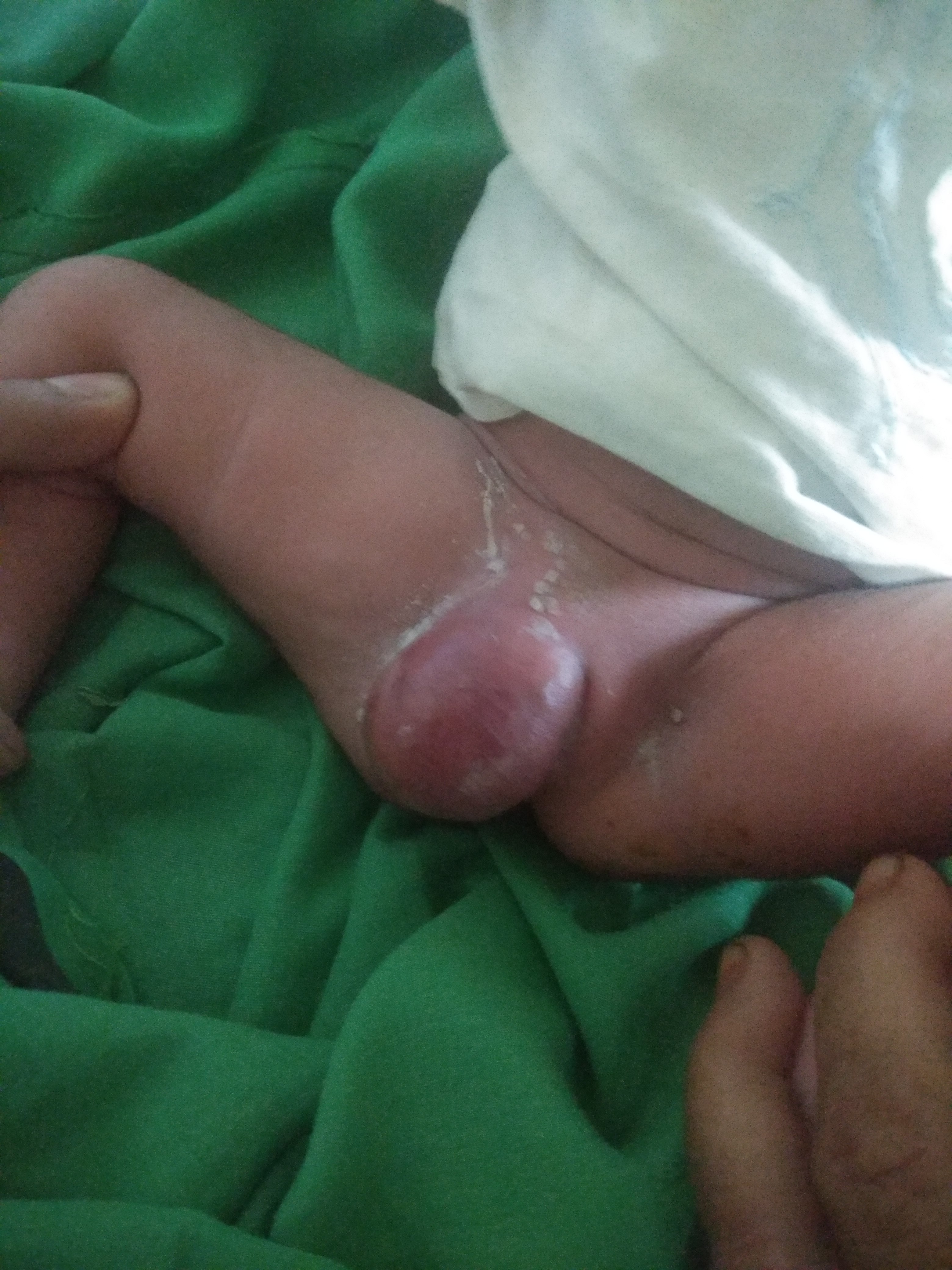 Swelling In Neonate For Last 3 Days