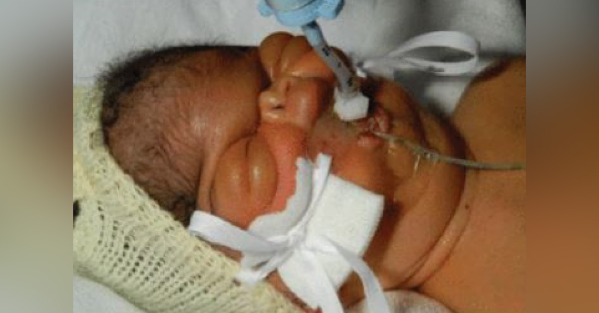 Identify This Rare Genetic Disorder