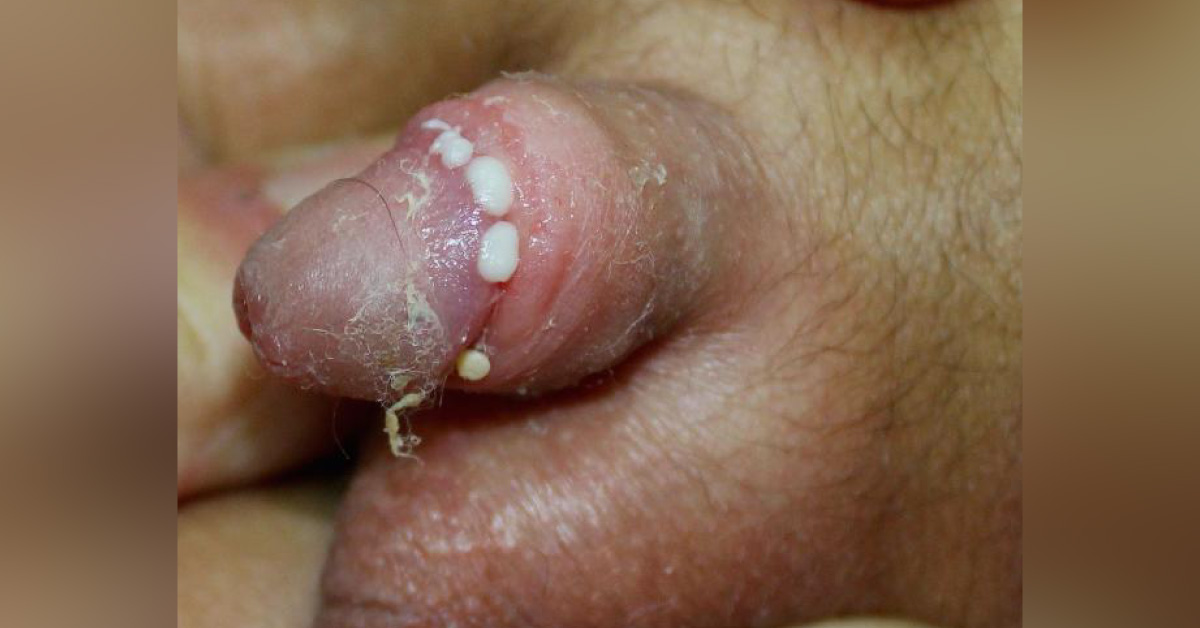 Smegma Production Doesn't Stop After Circumcision