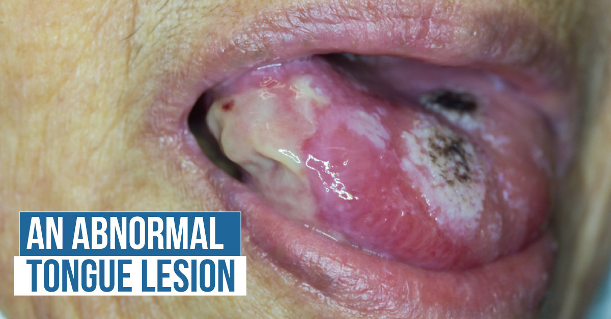 Decode the Case of This Young Woman with a Tongue Lesion