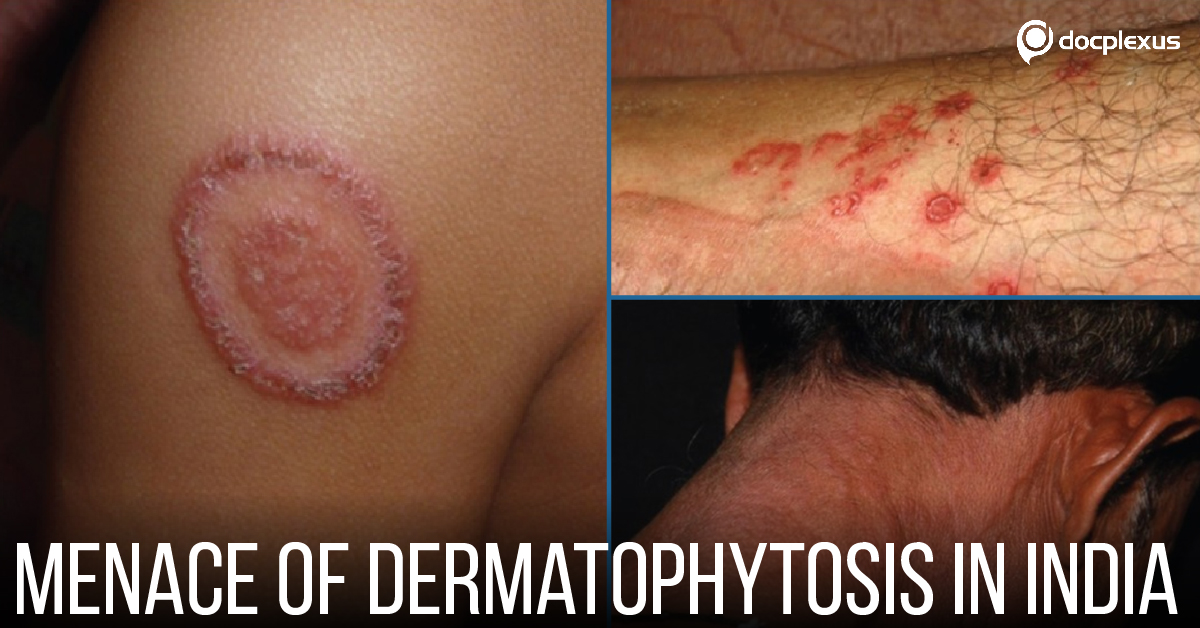 Alarming Rise In Dermatophytosis In India