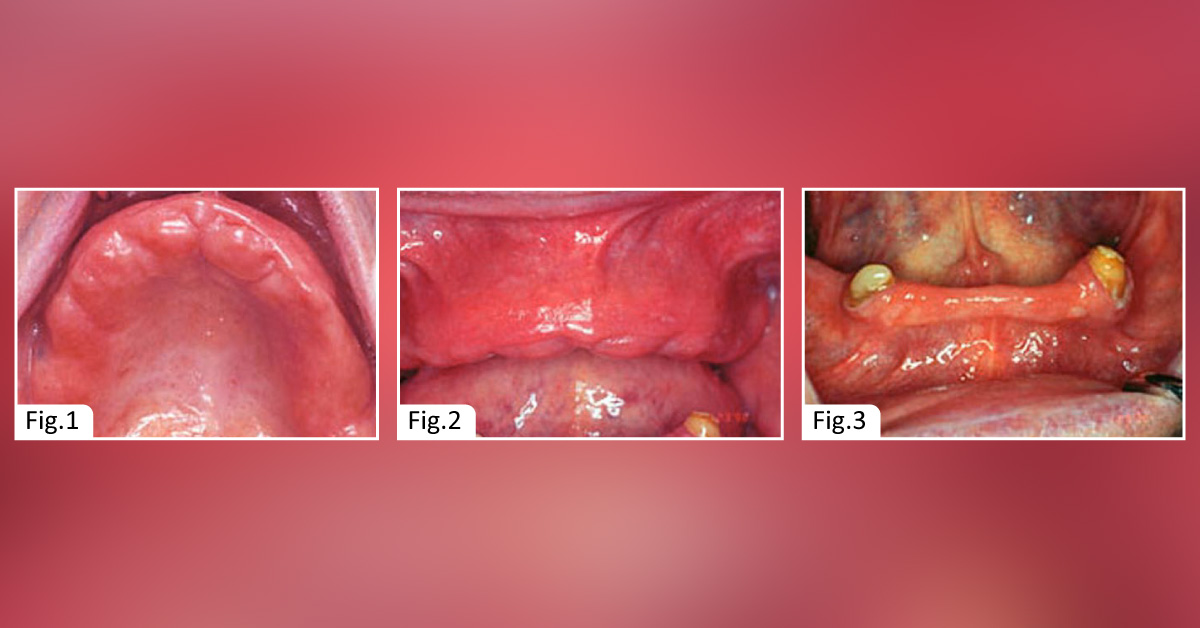 An Geriatric Elderly Male With Constant Oral Soreness