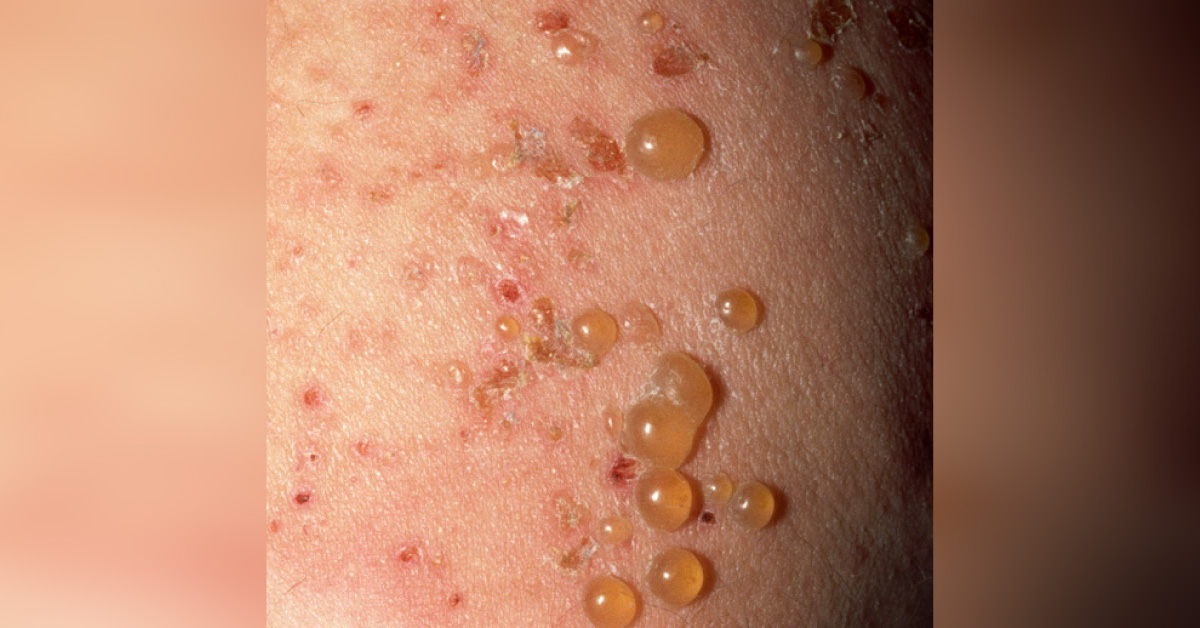 An Elderly Woman With Widespread Aggravating Eruptions