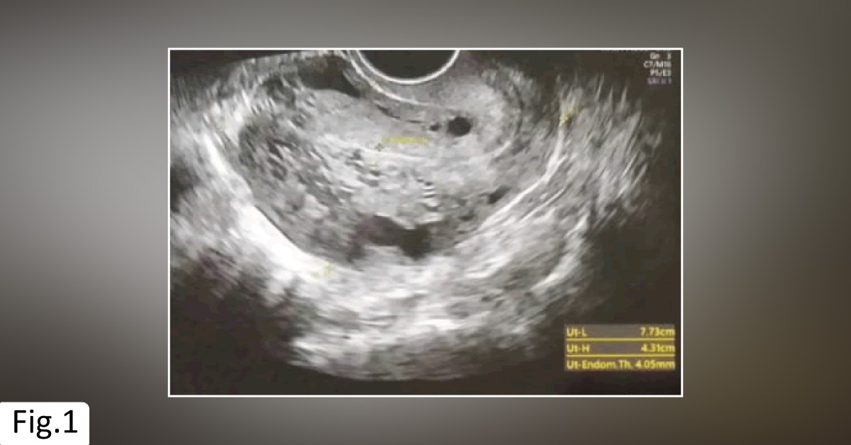 An Unusual Case Of Uterine Bleeding