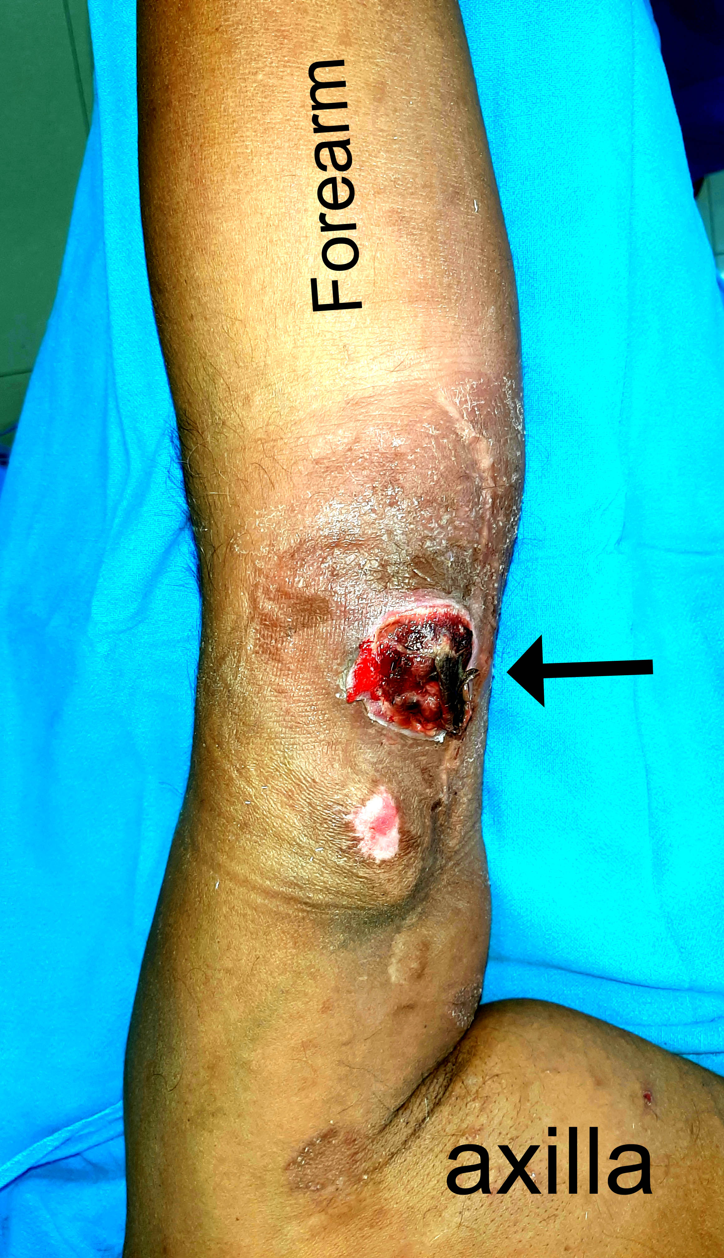 Use Of The Lowly Foley Catheter To Control A Major Bleed