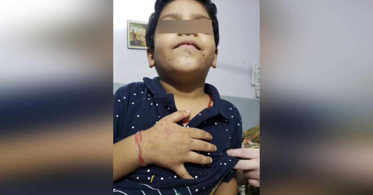 What Is This Skin Problem In A 5 Year Old Child?