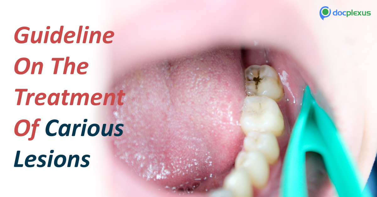 Carious Lesions Nonrestorative Treatment : Clinical Practice Guidelines