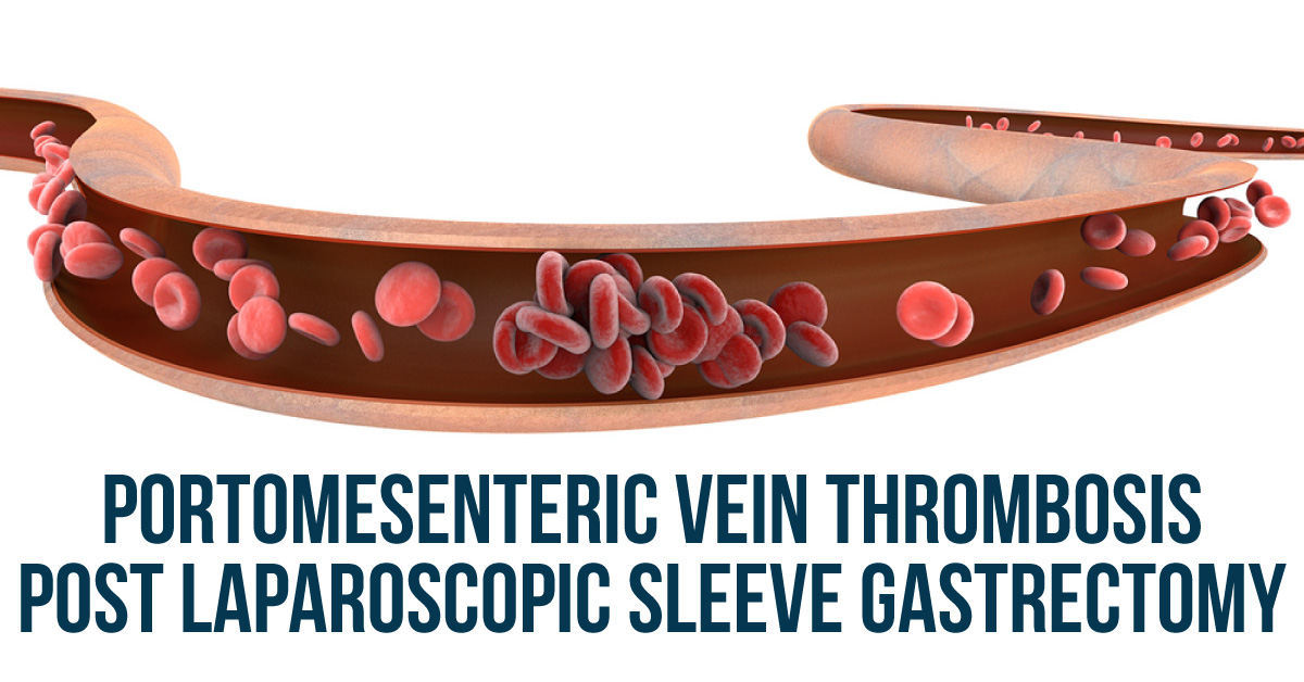 A Rare And Severe Complication Of PMVT Post Laparoscopic Sleeve Gastrectomy