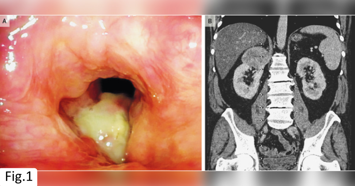 An Unusual Case of Voice Change and Pain While Swallowing