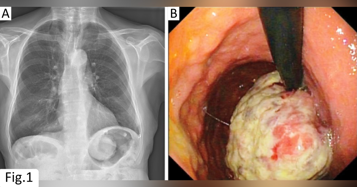 An Elderly Male with Progressive Edema in Both the Legs