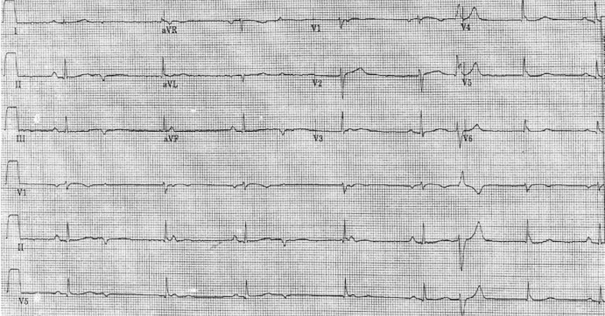Interpret the ECG