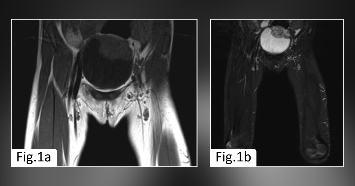 A Child with Recurrent Episodes of Hematuria