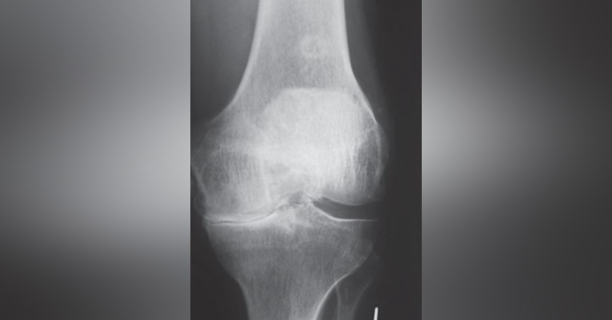 Case of a Woman with Progressive and Chronic Pain in Her Left Knee