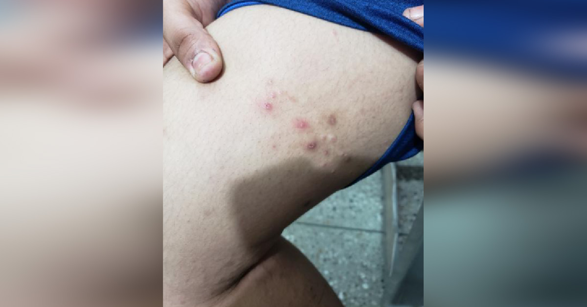 What Is The Skin Problem In This Teenager?