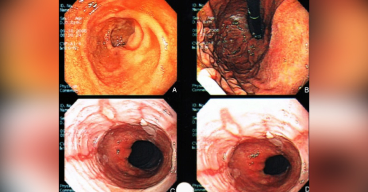 Case of an Elderly Man with Multiple Episodes of Hematemesis