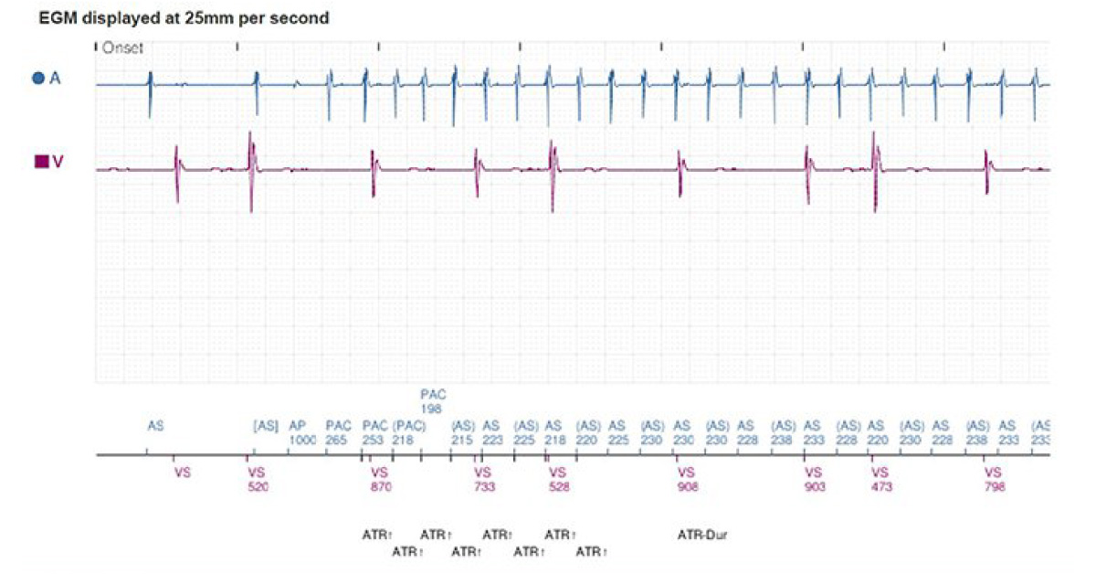 An Elderly Woman With High Atrial Rates