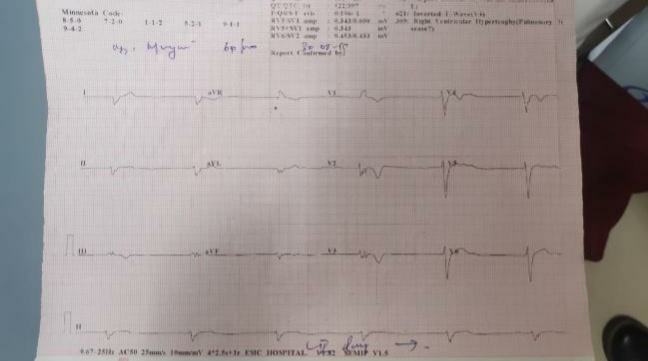 Before Deciding Pacemakers