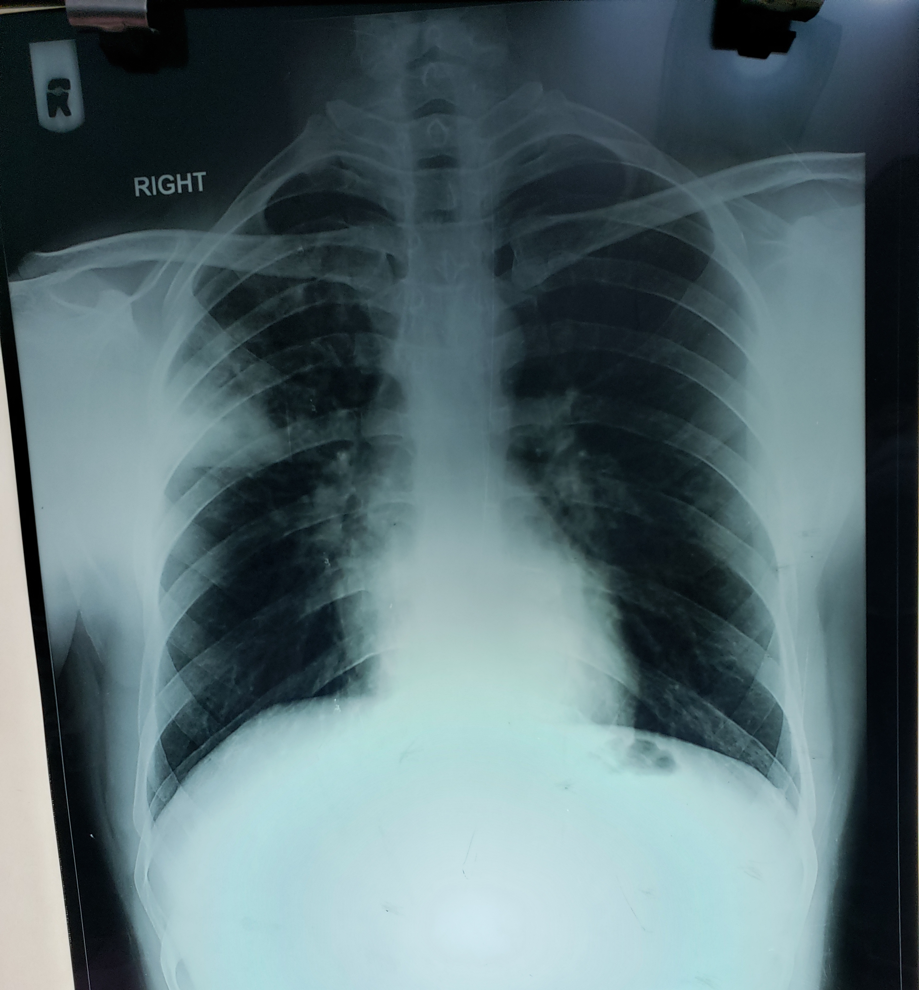 Why Rt Upper Ribs Are Crowded?