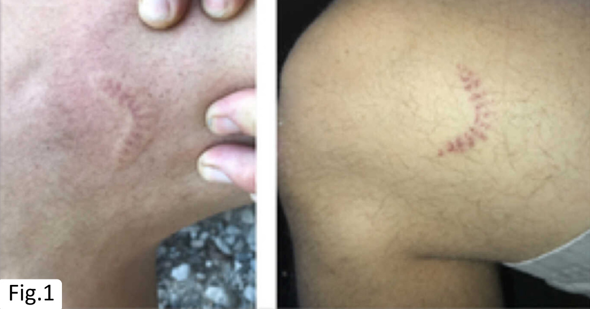 A Man With Painful Urticated Plaque On The Left Thigh