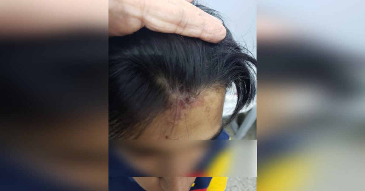 Skin Problem In A Teenager