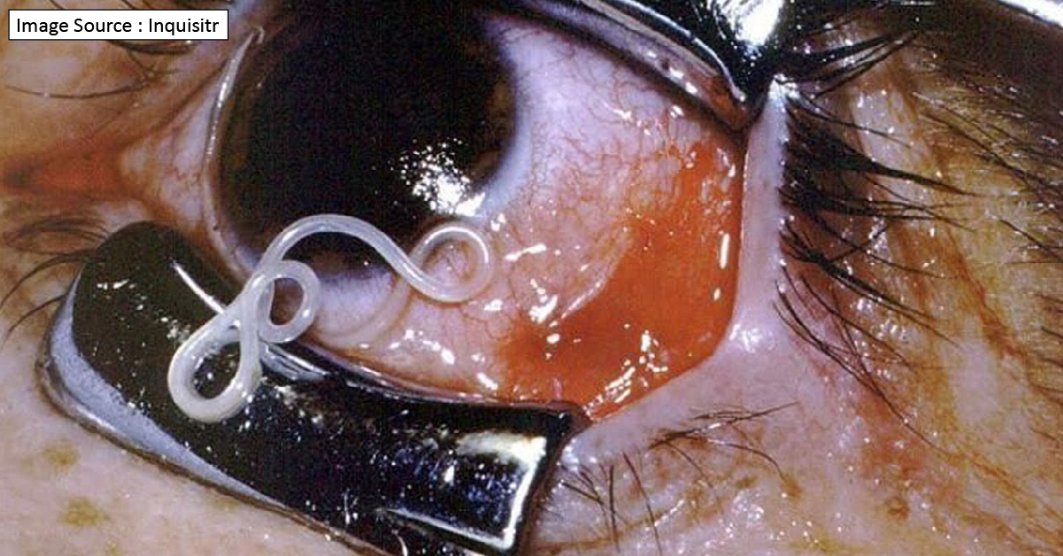 A Rare Case Of Intraocular Parasitosis