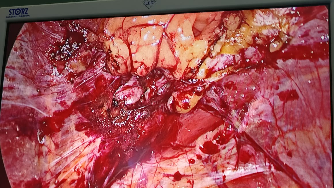 Difficult Lap Chole Performed Successfully With Adhesiolysis