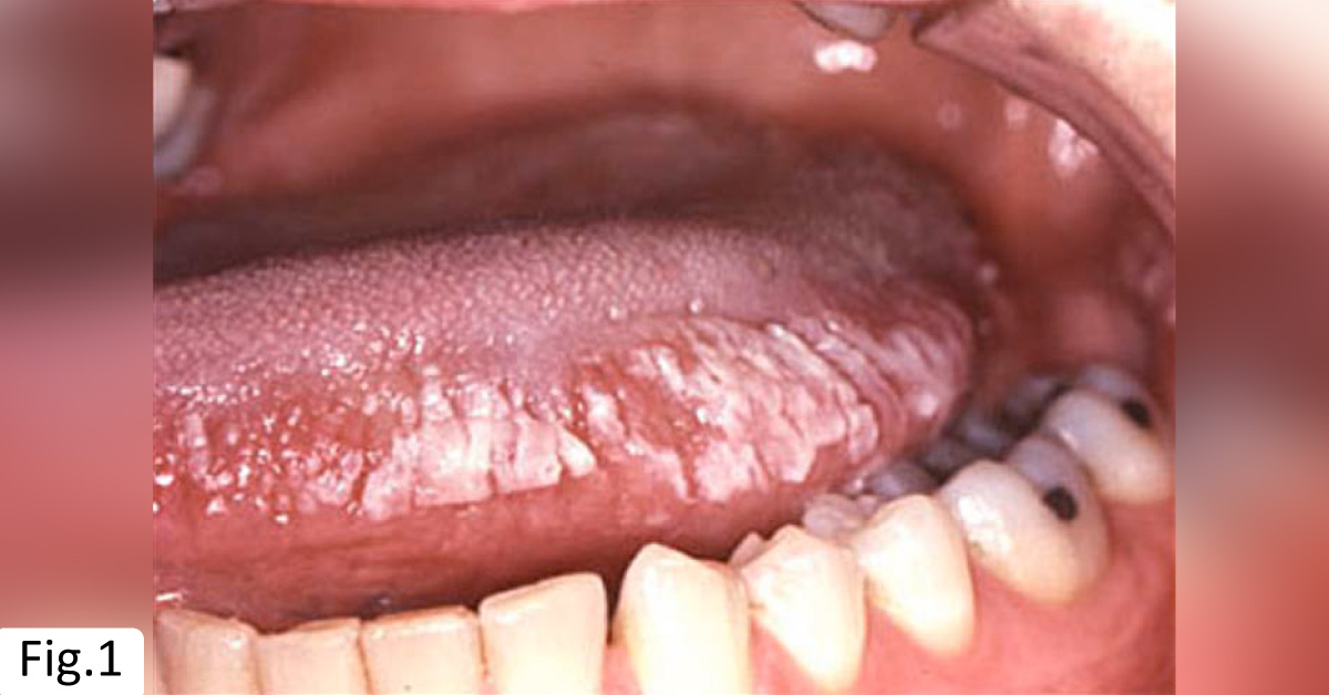 Left Lateral Tongue With An Irritating Sensation