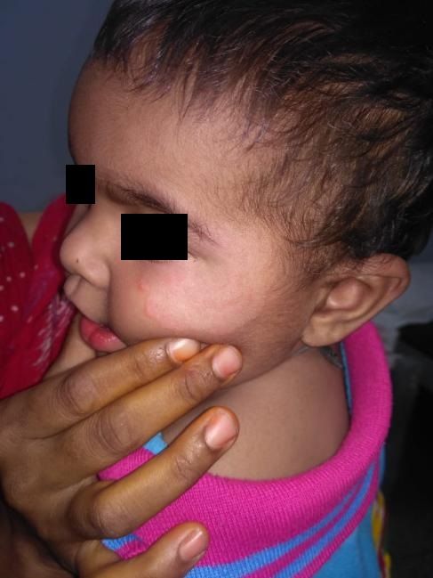 Ringworm Infection Of Face In 6 Month Infant ?