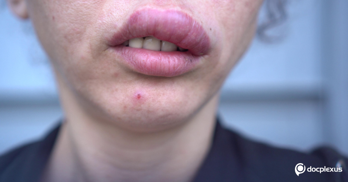 An Unexplained Case Of Angioedema