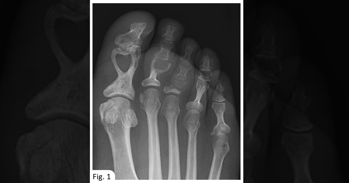 A Patient With A Long-Standing History Of Hand And Feet Swelling