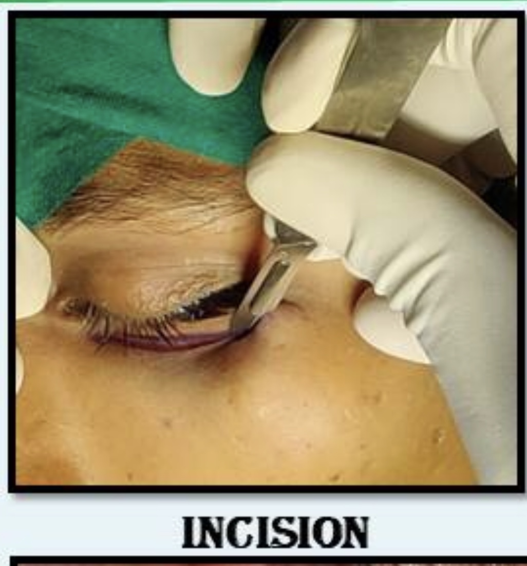 Untreated Case Of Diplopia Post Injury