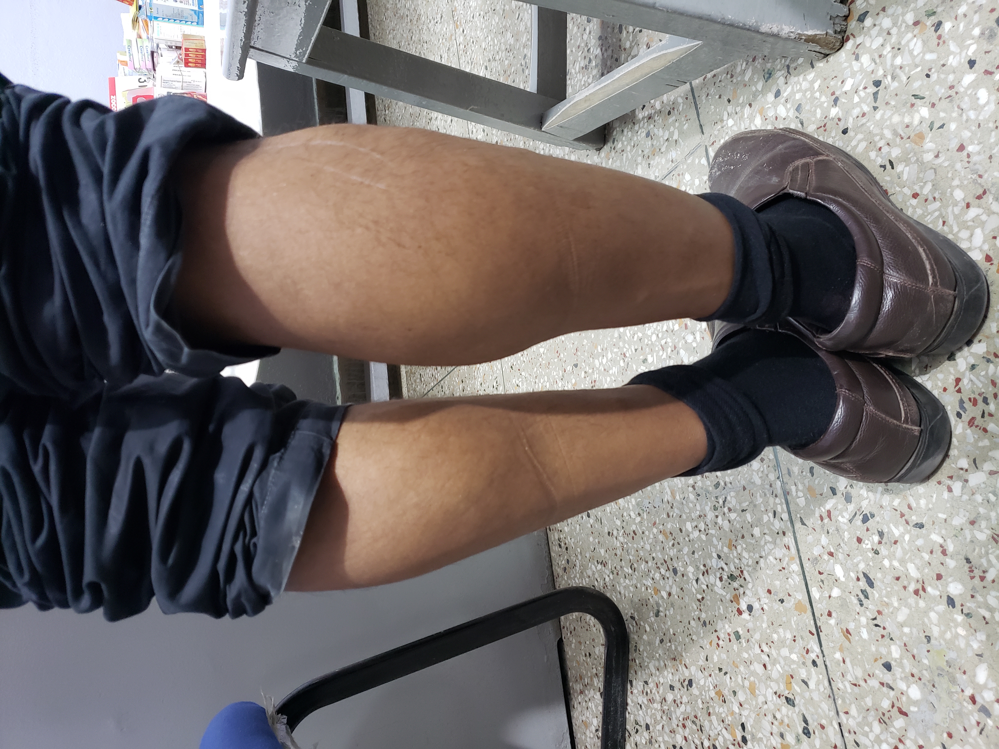 Is This A Muscular Dystrophy Or Hypertrophy?