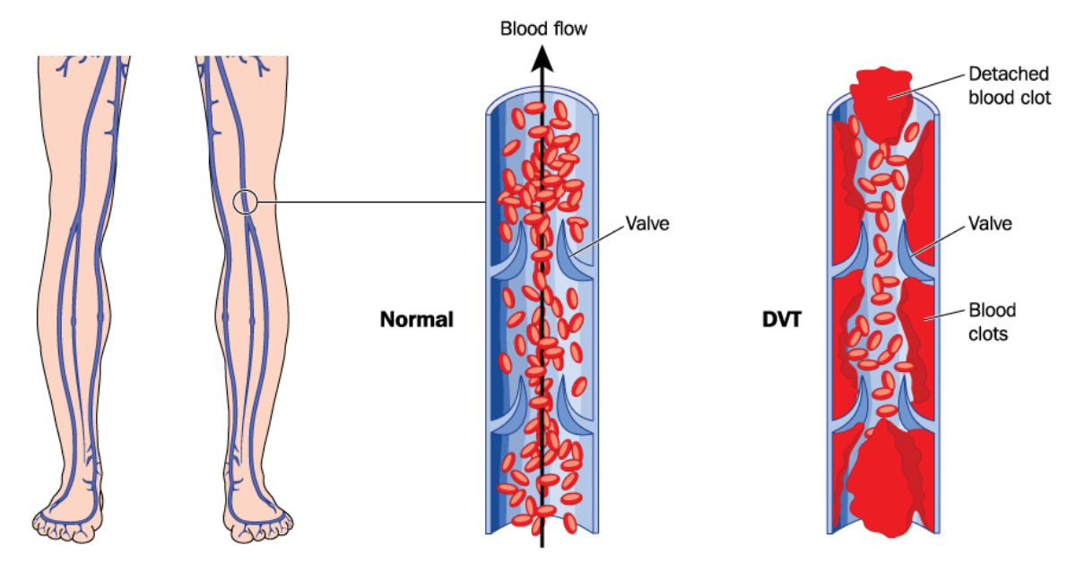 Thrombosis- A Killer