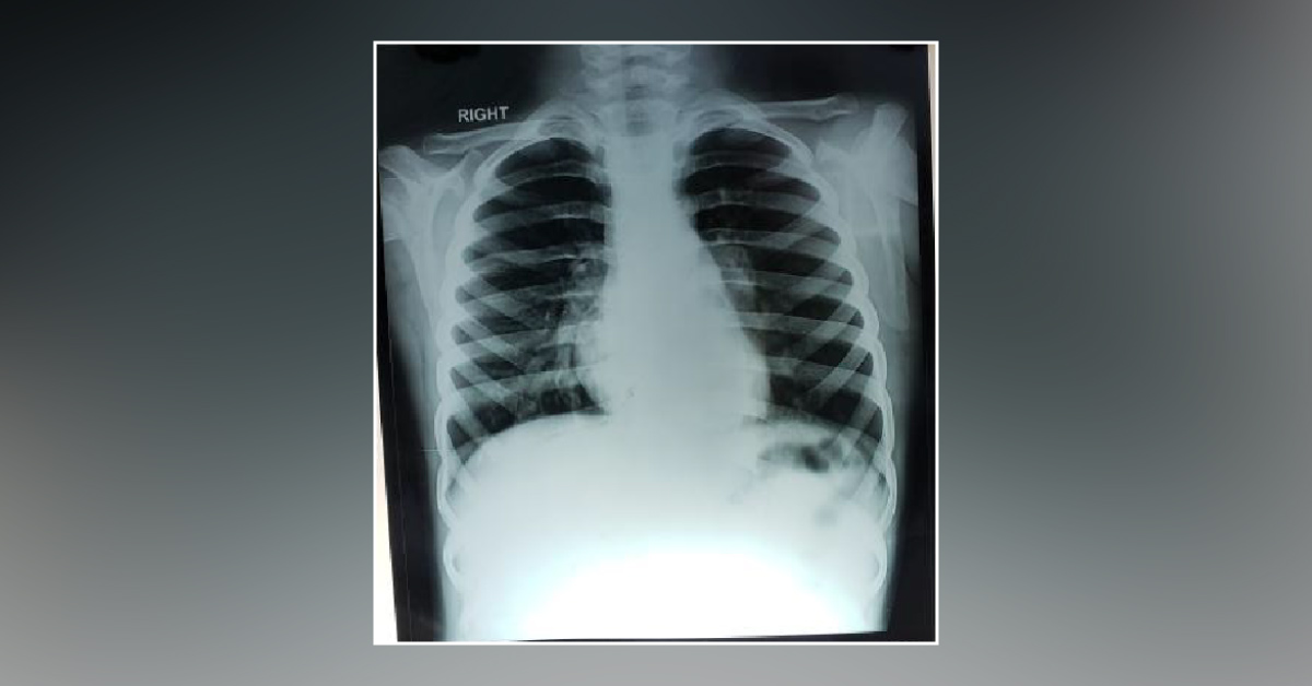 What Is This Structure In This X-ray Chest PA View?