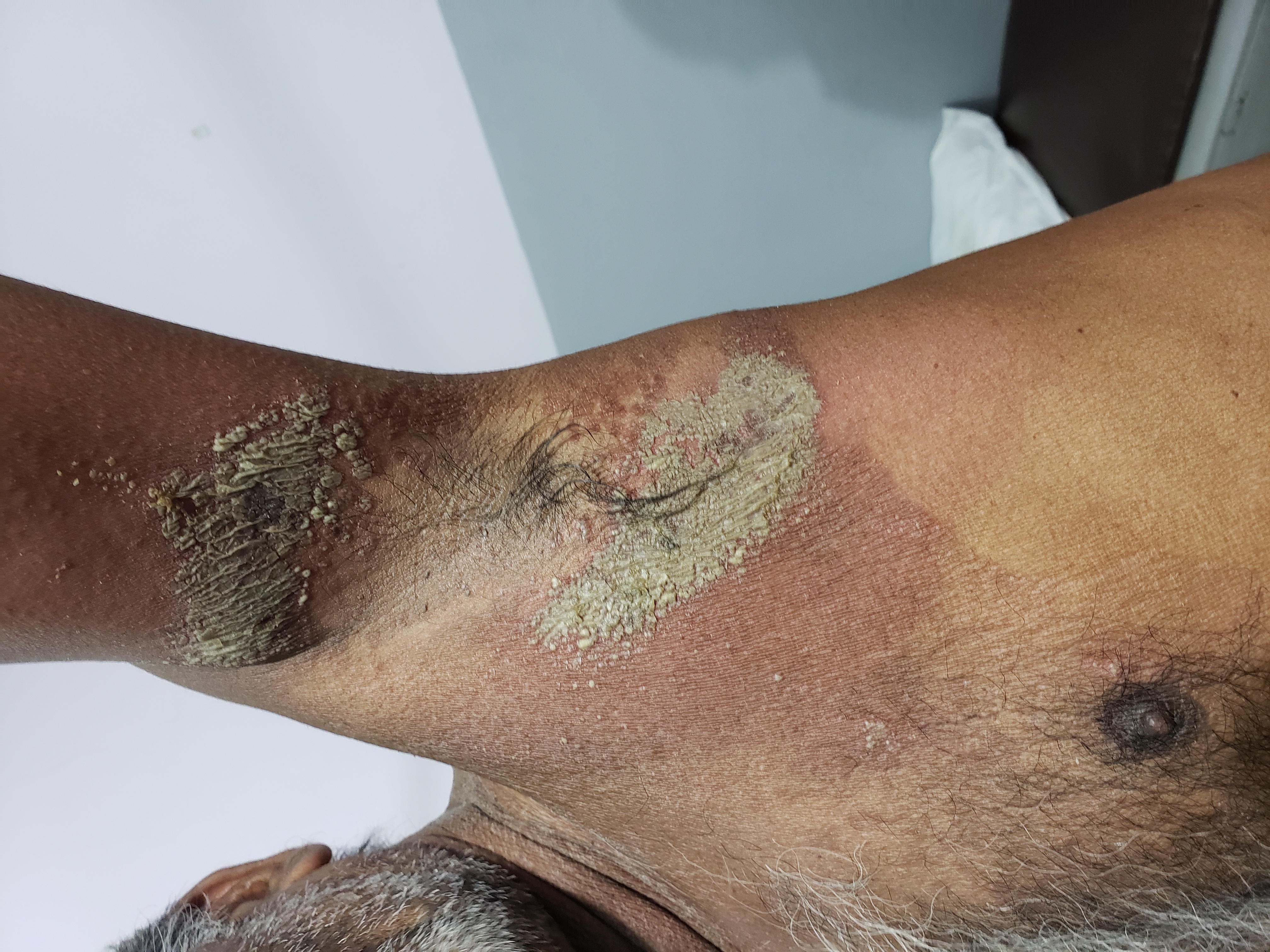 What Is This Secondary Manifestation Over Old Tinea Corporis Infection In Axillae?