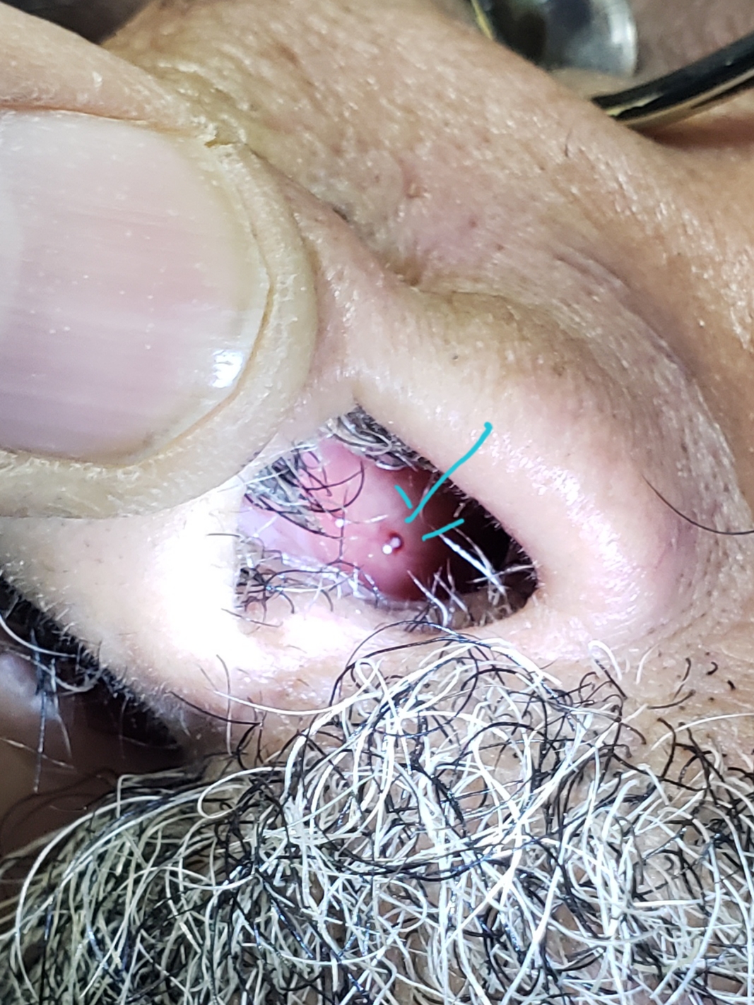 What Is This Lesion In Nose Over Nasal Septum?