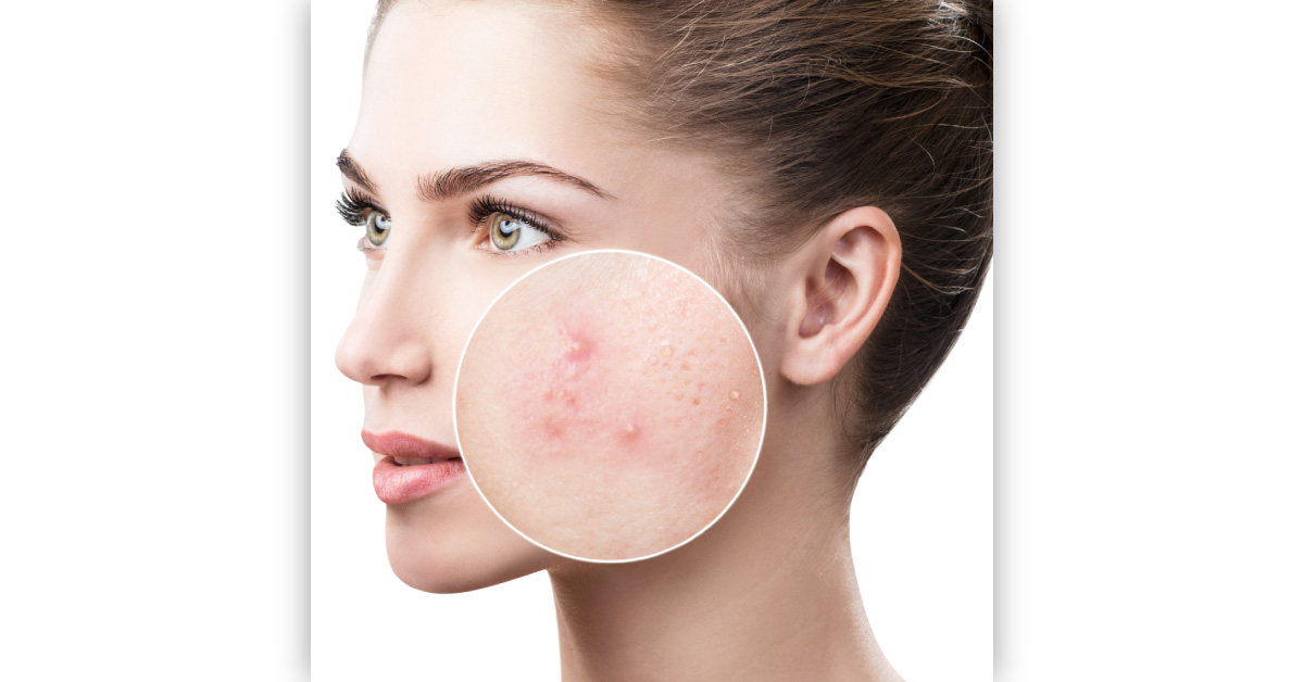 Study: Consumption Of Sweets Causes Acne In Young People