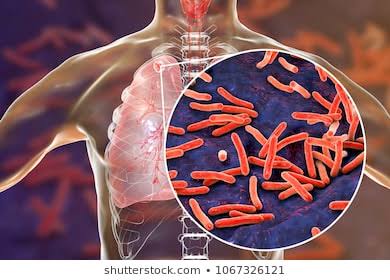 Door to door TB PTs search to eradicate TB by 2025 as promised by PM