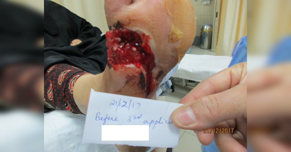 Chronic Diabetic Foot Ulcer
