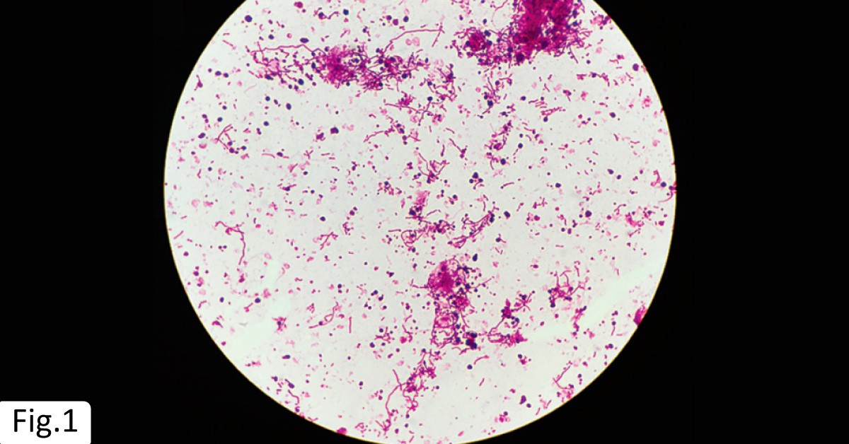 A Case of Recurrent Sore Throat and Fever