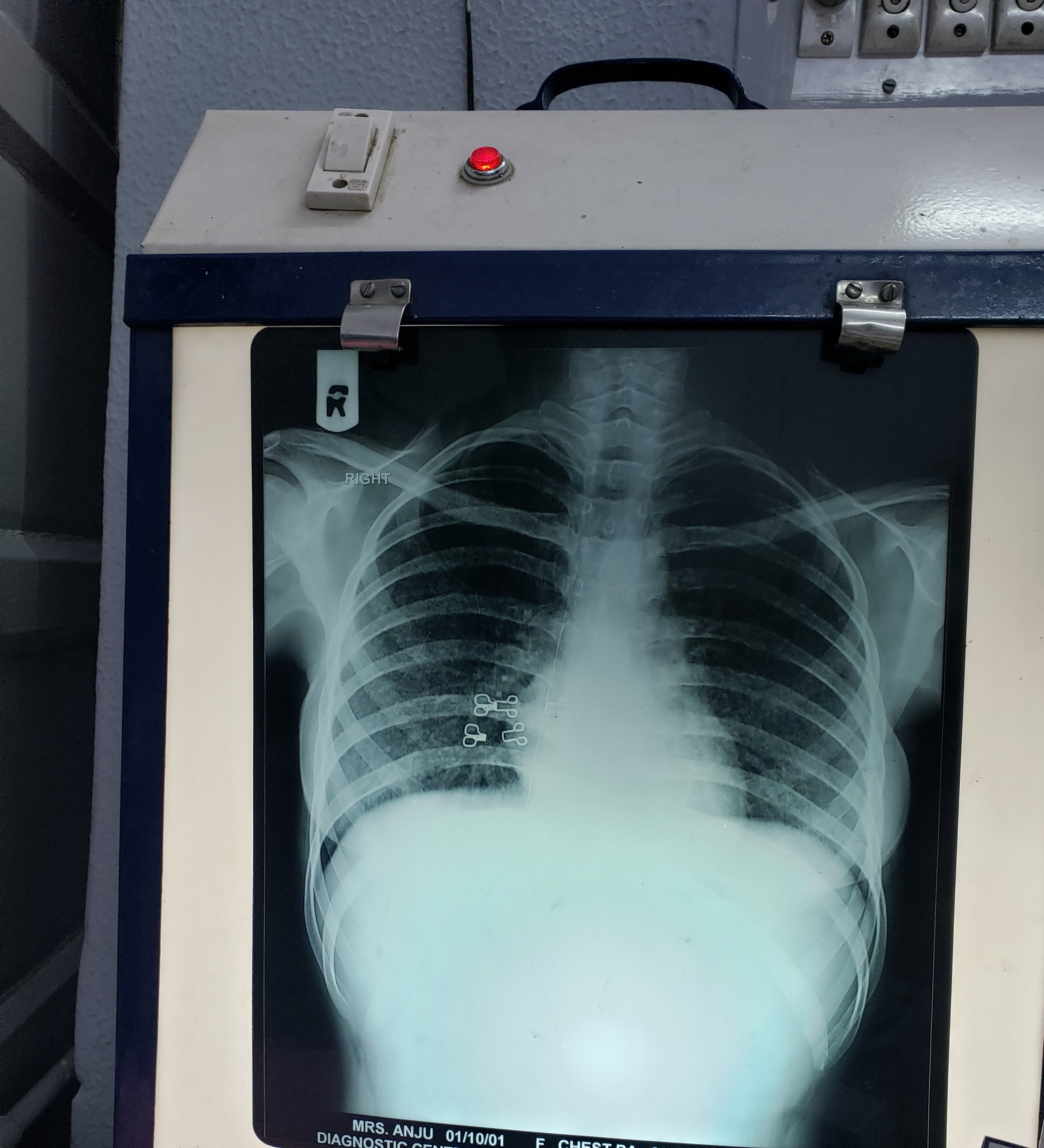 What Kind Of Shadows Are Seen In Lower Zones Of Lungs?